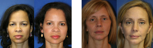 Facelift Before & After Photos