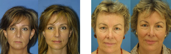 Facelift Before & After Photos